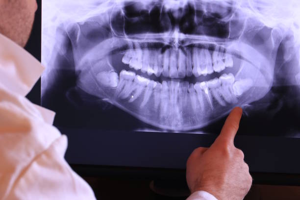 Best Emergency Wisdom Teeth Removal in Siler City, NC