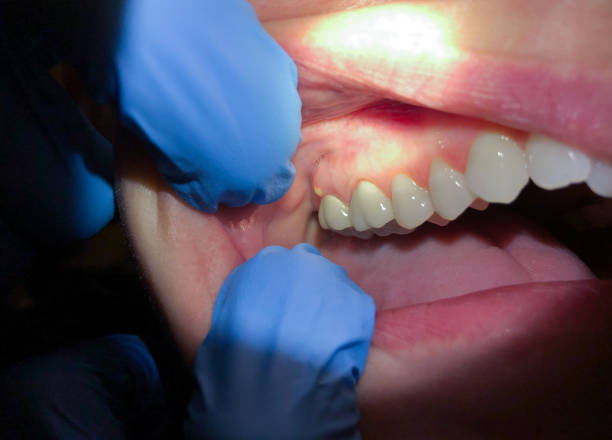 Best Emergency Wisdom Teeth Removal in Siler City, NC